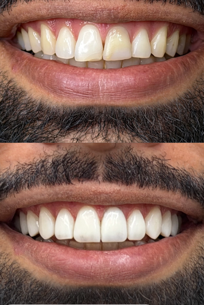 Caso 1: comparação do sorriso, antes na parte superior e depois na parte inferior