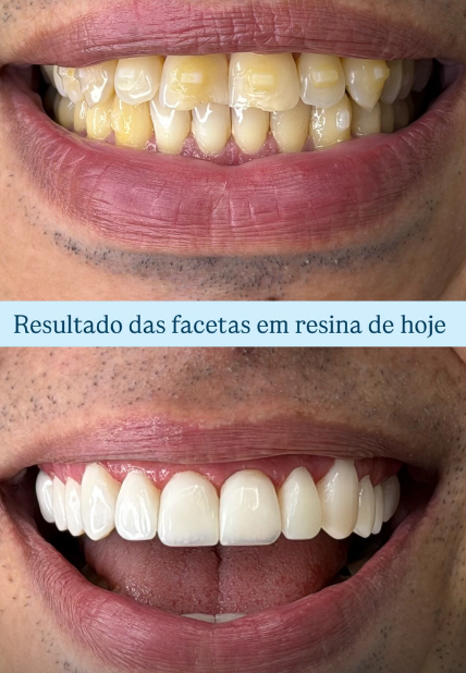 Caso 2: comparação do sorriso, antes na parte superior e depois na parte inferior