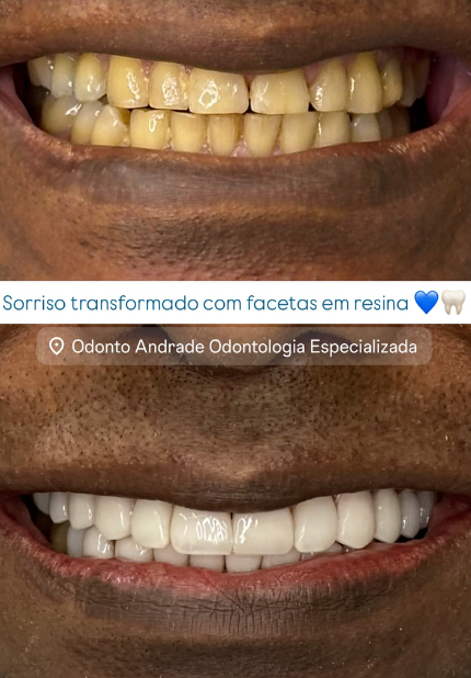 Caso 3: comparação do sorriso, antes na parte superior e depois na parte inferior